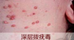 激光疗法有什么作用激光动力综合疗法1—2个疗程有效治疗扁平疣_https://www.jmylbn.com_新闻资讯_第7张