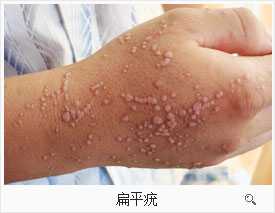 激光疗法有什么作用激光动力综合疗法1—2个疗程有效治疗扁平疣_https://www.jmylbn.com_新闻资讯_第1张