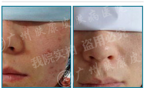 激光疗法有什么作用激光动力综合疗法1—2个疗程有效治疗扁平疣_https://www.jmylbn.com_新闻资讯_第10张