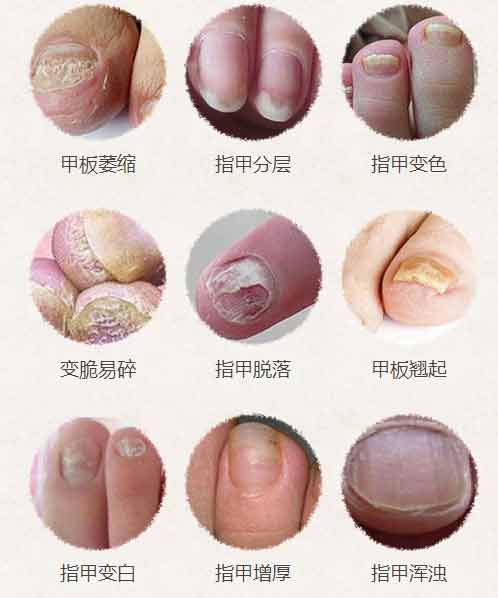 >>>您属于哪种类型的灰指甲?点击预约医生